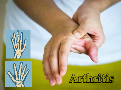 درمان آرتروز