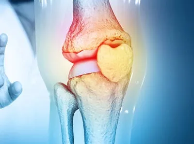 الارتریت مکمل ضد التهاب